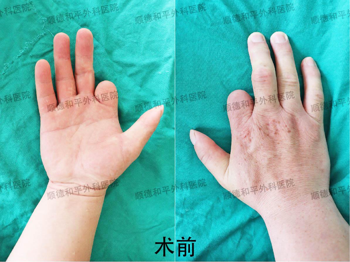 新疆患者失去手指心生自卑，遠(yuǎn)赴廣東手指再造＿手外科醫(yī)院咨詢(圖1)