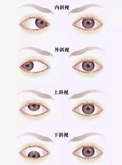 愛爾眼科：總愛偏頭看，視力“一好一壞”？警惕斜視！(圖1)