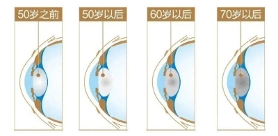 愛爾眼科：白內障不會“缺席”只會“遲到”？(圖6)
