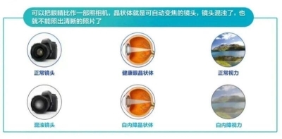 愛爾眼科：白內障不會“缺席”只會“遲到”？(圖1)