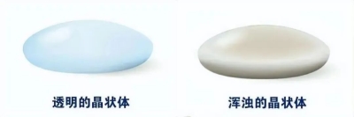 愛爾眼科：白內障不會“缺席”只會“遲到”？(圖3)