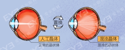 愛爾眼科：白內障不會“缺席”只會“遲到”？(圖4)